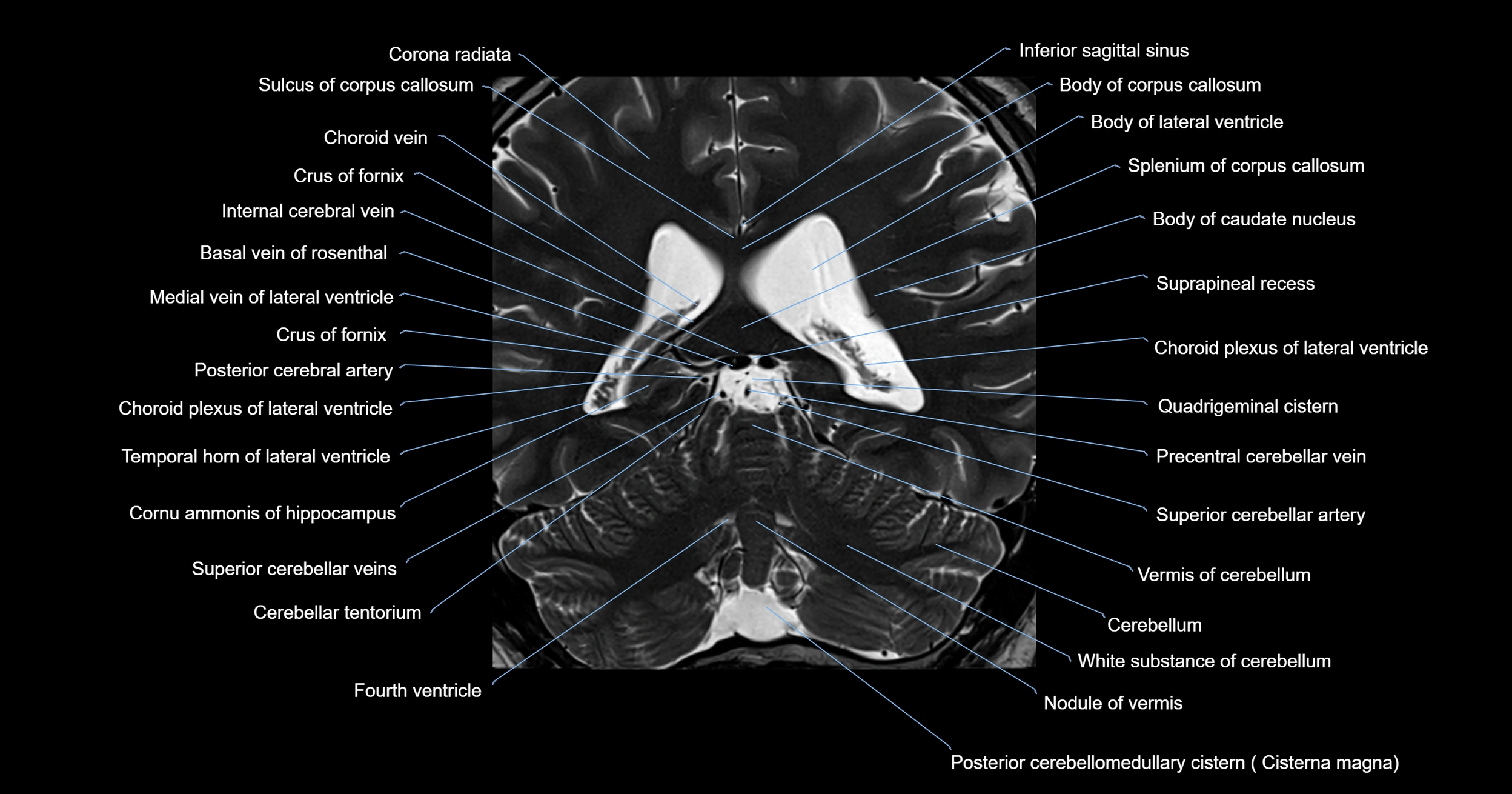 MRI brainstem & basal ganglia anatomy labelled 3T MRI images -img-00001-00033.webp